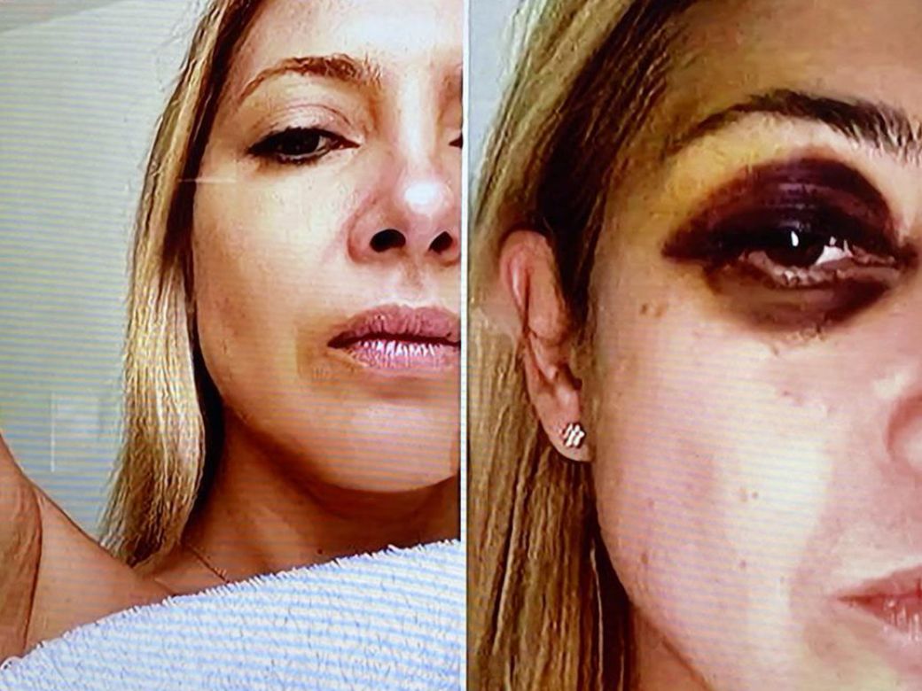 Alberto dijo que la foto de Fabiola con un ojo hinchado «es falsa»: «ese golpe nunca existió»