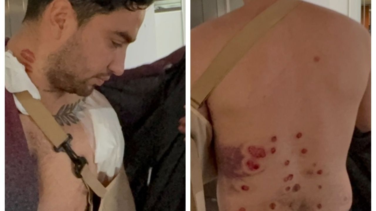 Están investigando a policías piquenses por herir a un joven con postas de goma