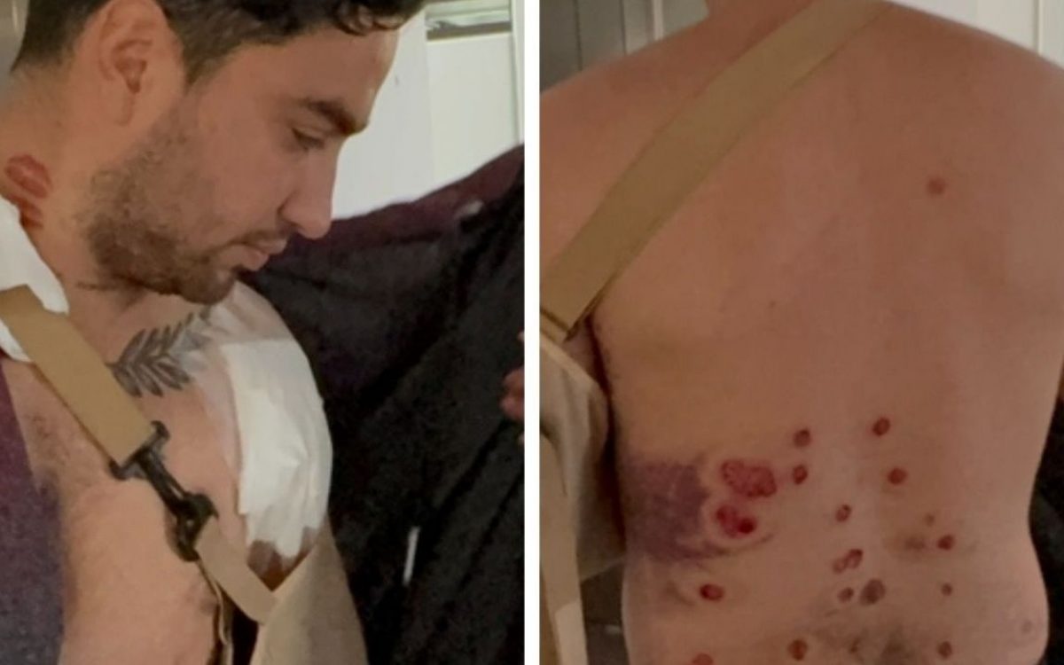 Están investigando a policías piquenses por herir a un joven con postas de goma